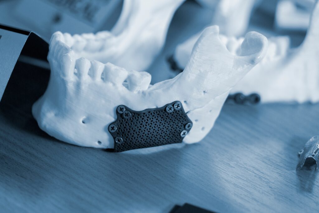 Prototype,Of,Lower,Human,Jaw,With,Medical,Titanium,Implant,From 3D printing protoype